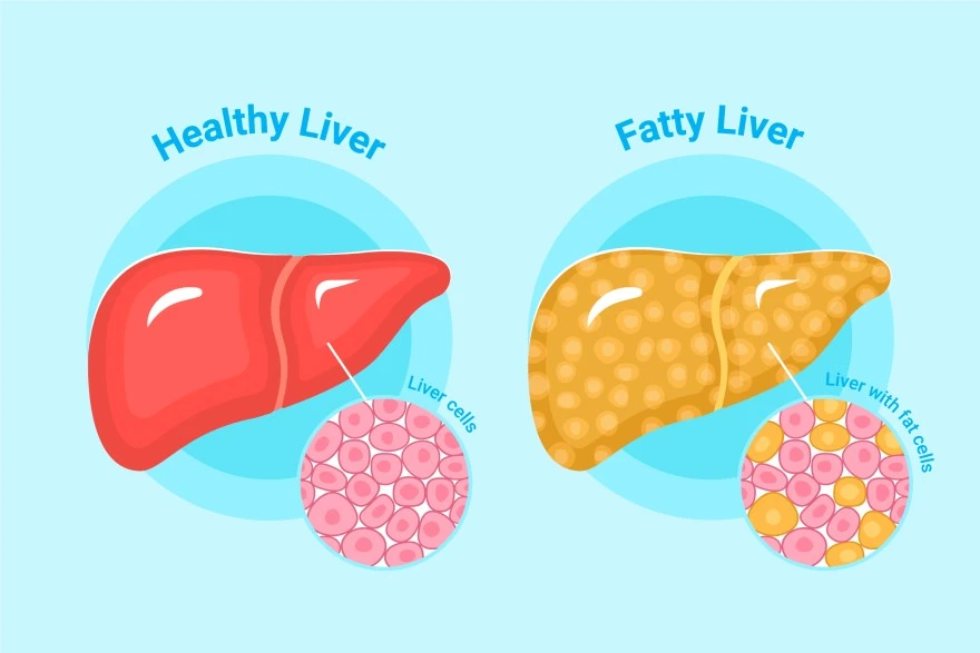 Nonalcoholic Fatty Liver Disease Symptoms